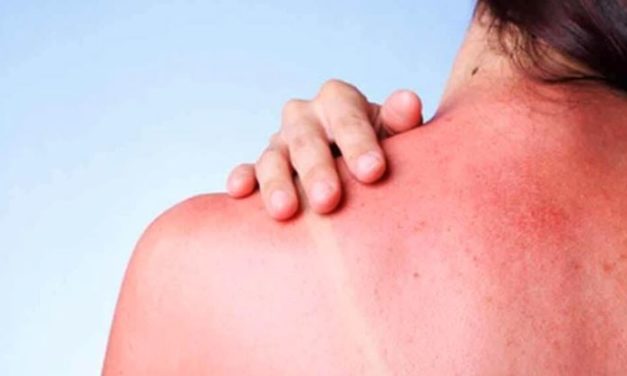<strong>ANTE AUMENTO DE TEMPERATURA, LLAMA IMSS NAYARIT A EXTREMAR  MEDIDAS PREVENTIVAS PARA EVITAR LESIONES SOLARES</strong>