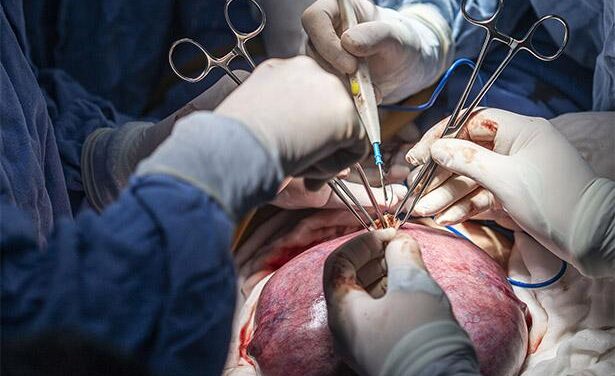 Especialistas del IMSS en La Raza realizan exitosa cirugía fetal para corregir espina bífida