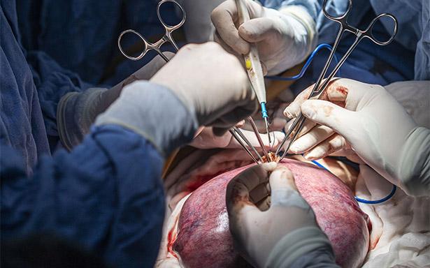 Especialistas del IMSS en La Raza realizan exitosa cirugía fetal para corregir espina bífida