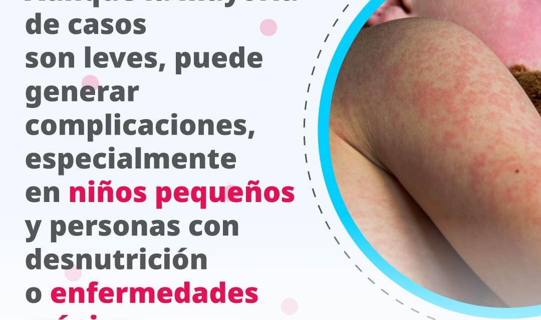 VACÚNATE CONTRA EL SARAMPIÓN Y PROTEGE TU SALUD